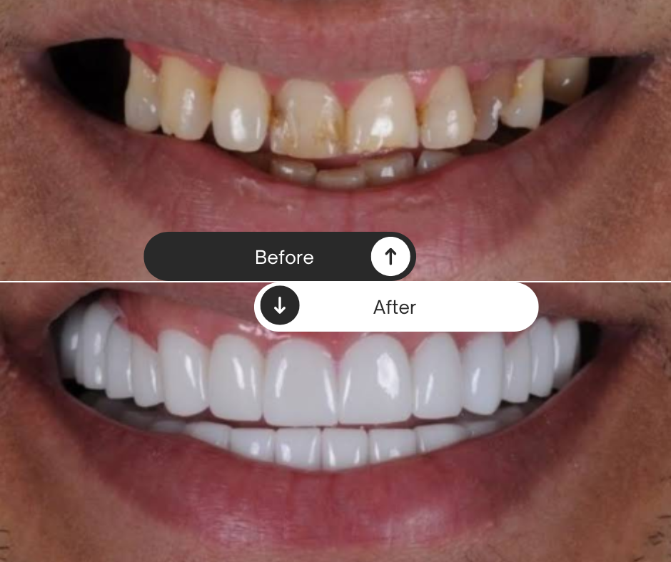 Fall 1: Full mouth Veneers + crowns - Before and after dental transformation