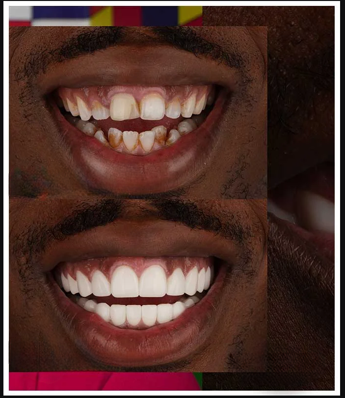 Smile transformation 4