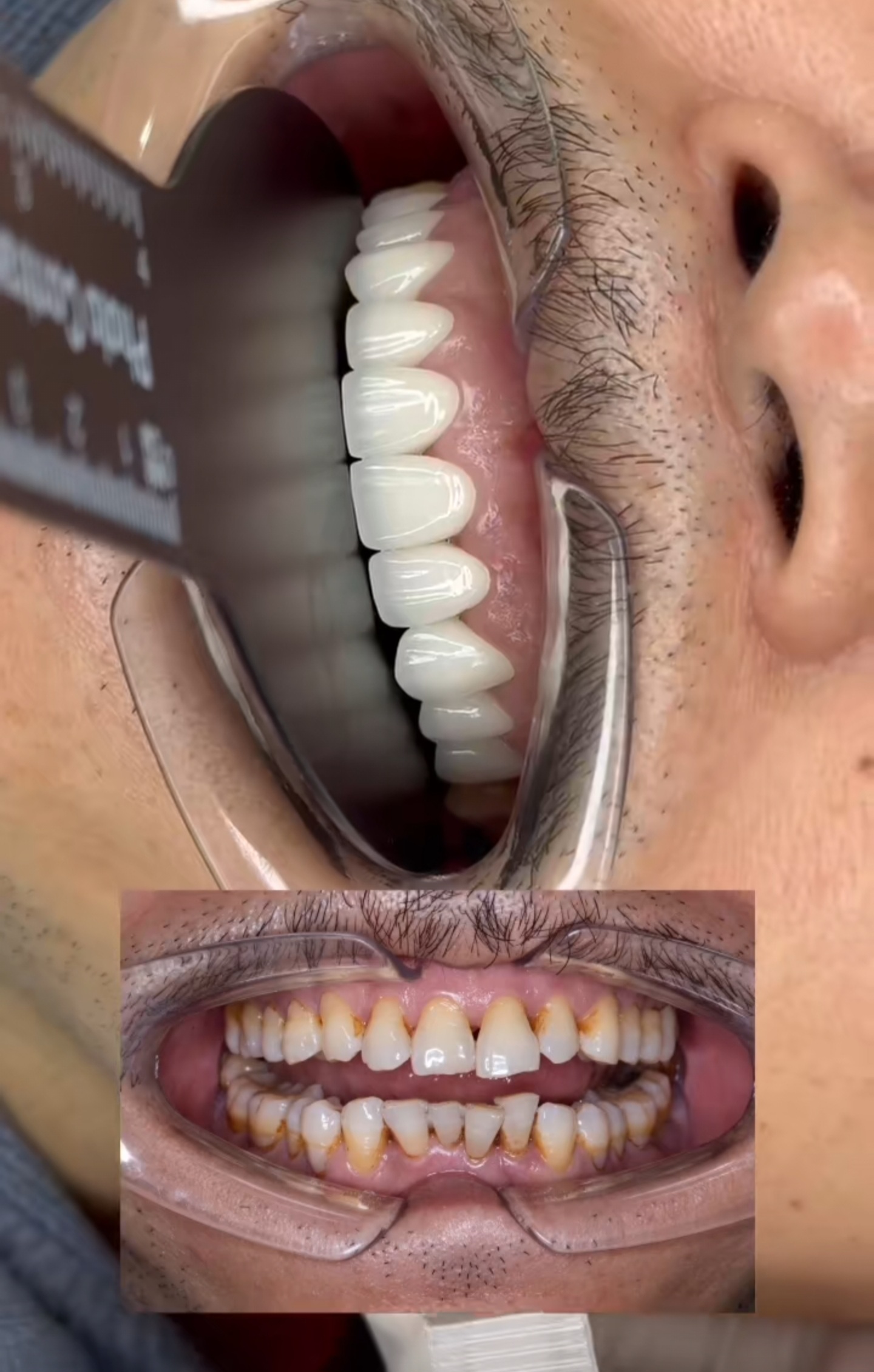 Smile transformation 8